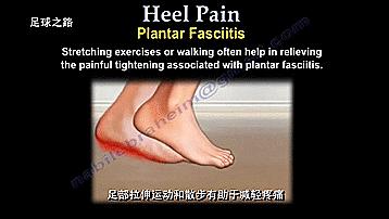 足跟痛最常见病因,足跟痛警惕四种疾病