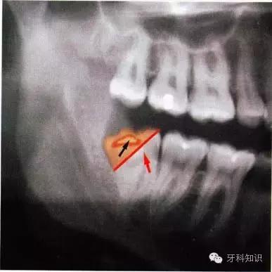 口腔拔牙图片,口腔拔牙麻醉多久消退