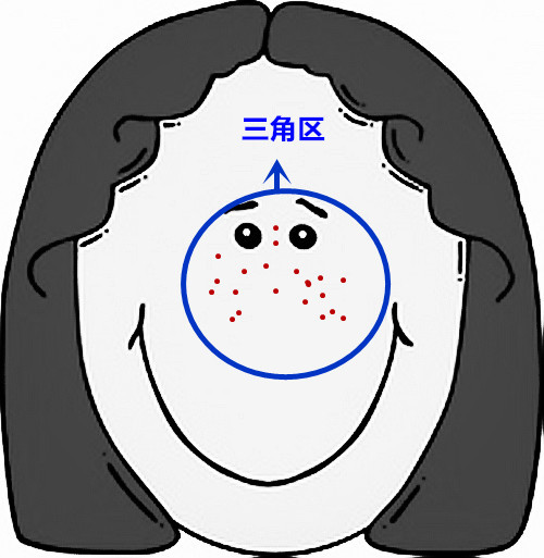 面部痘痘严重程度检测,痘痘面部分析