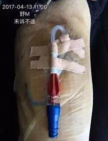 皮炎可以用的医用敷料,过敏性皮炎可以用医用敷料吗