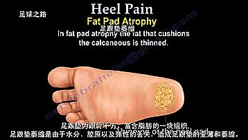 足跟痛的症状及表现,足跟痛最常见病因