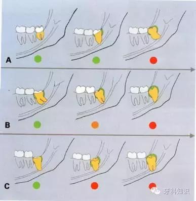 口腔拔牙图片,口腔拔牙麻醉多久消退