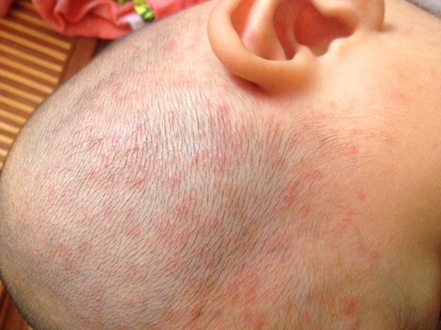 宝宝长痱子用什么方法最有效,预防宝宝长痱子用什么方法最有效