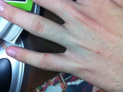 全身突然出现很多小红痣不痛不痒,身上突然长很多小红痣是什么原因