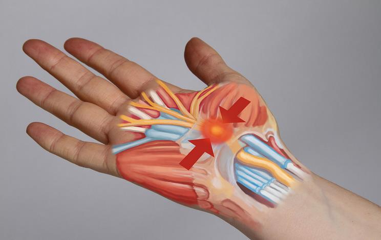 就医搜｜腕管综合征：容易在键盘上“敲”出的疾病！