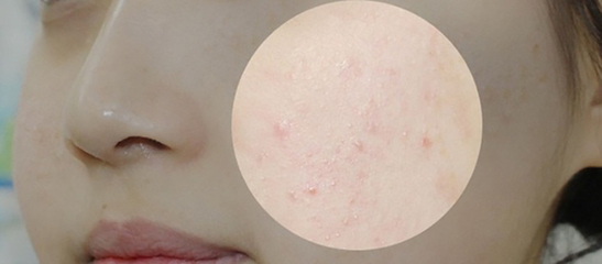 闭口粉刺做什么皮肤管理,皮肤管理粉刺