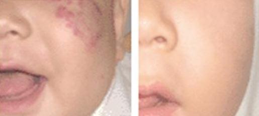 胎记表面粗糙像结痂,胎记表面有小疙瘩