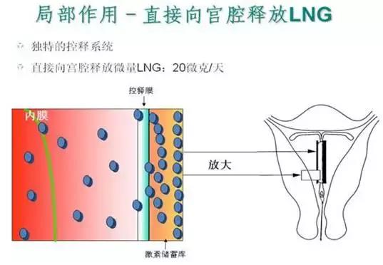节育环中的爱马仕,节育环曼月乐副作用