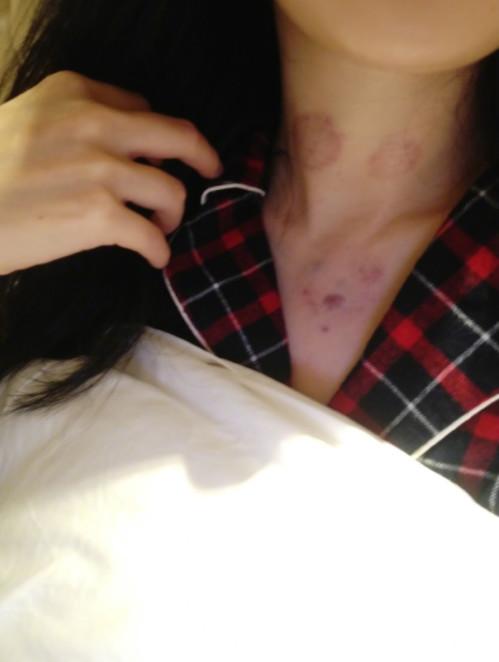 杨幂中医视频,杨幂针灸放血治疗