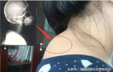 富贵包按摩和艾灸哪个效果好,艾灸液对富贵包有消除作用吗