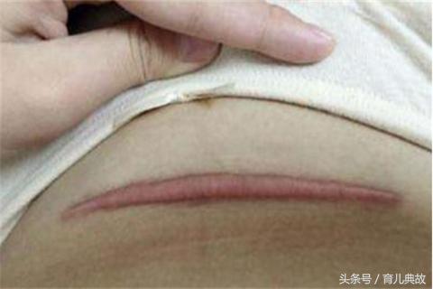 剖腹产后疤痕恢复情况变化,剖腹产疤痕恢复好了怎么有个坑