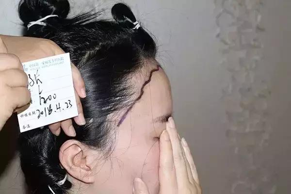 做了发际线还会长吗,做了发际线头型是不是比较好看
