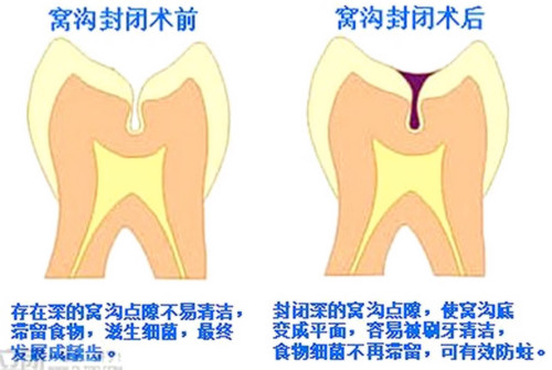 中老年人牙龋坏后果,大人龋齿不治疗会怎样