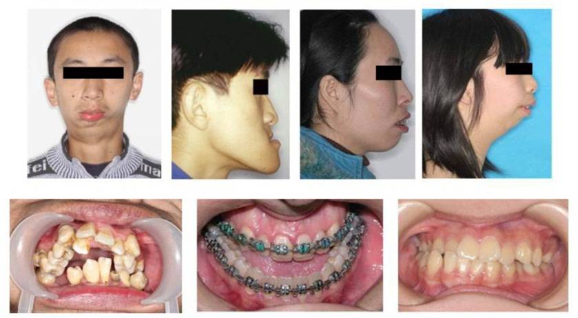 龅牙地包天怎么弄,龅牙怎么解决最好