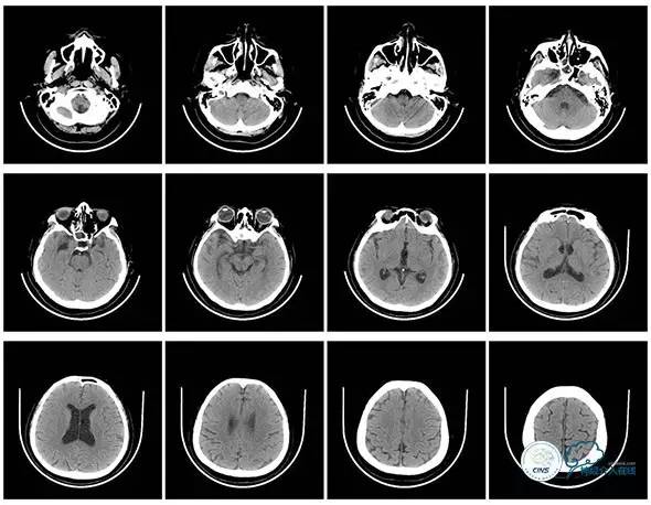 脑静脉窦狭窄做支架危险吗,静脉窦狭窄做支架后多久恢复