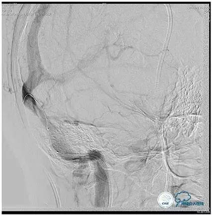静脉窦狭窄支架植入术,静脉窦狭窄做支架多少钱
