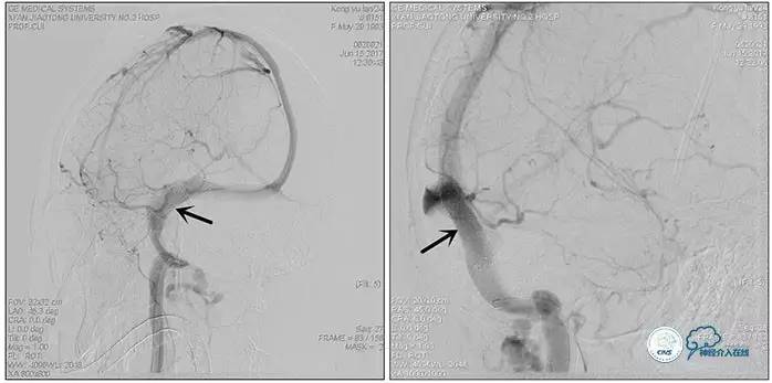 静脉窦狭窄支架植入术,静脉窦狭窄做支架多少钱