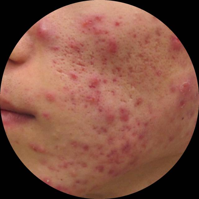 最全战痘攻略,战痘100种祛痘方法