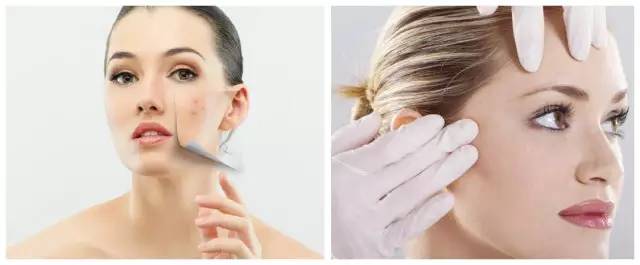 战痘大结局完整版,战痘合集完整版