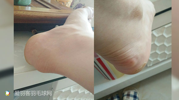 类风湿脚疼解决方法,80岁脚趾疼怎样治