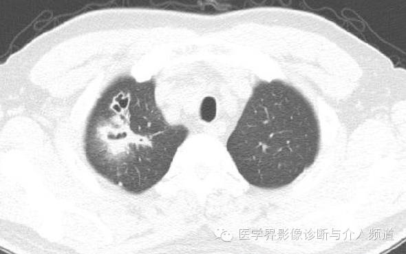 咳嗽排除了肺部的问题,咳嗽为什么比不咳好