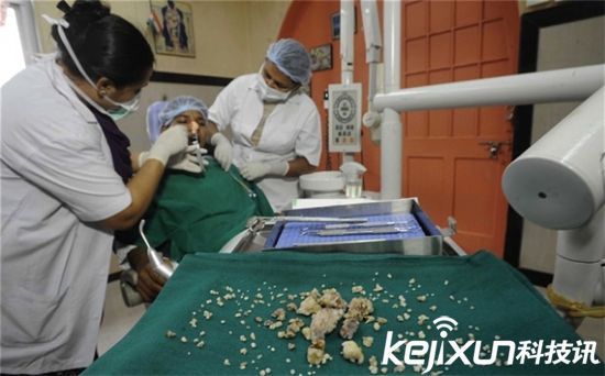 男孩嘴里有526颗牙,男孩多牙症300颗牙齿