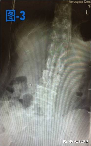 小针刀治疗脊柱侧弯,腰椎间盘突出脊柱侧弯的针刀治疗