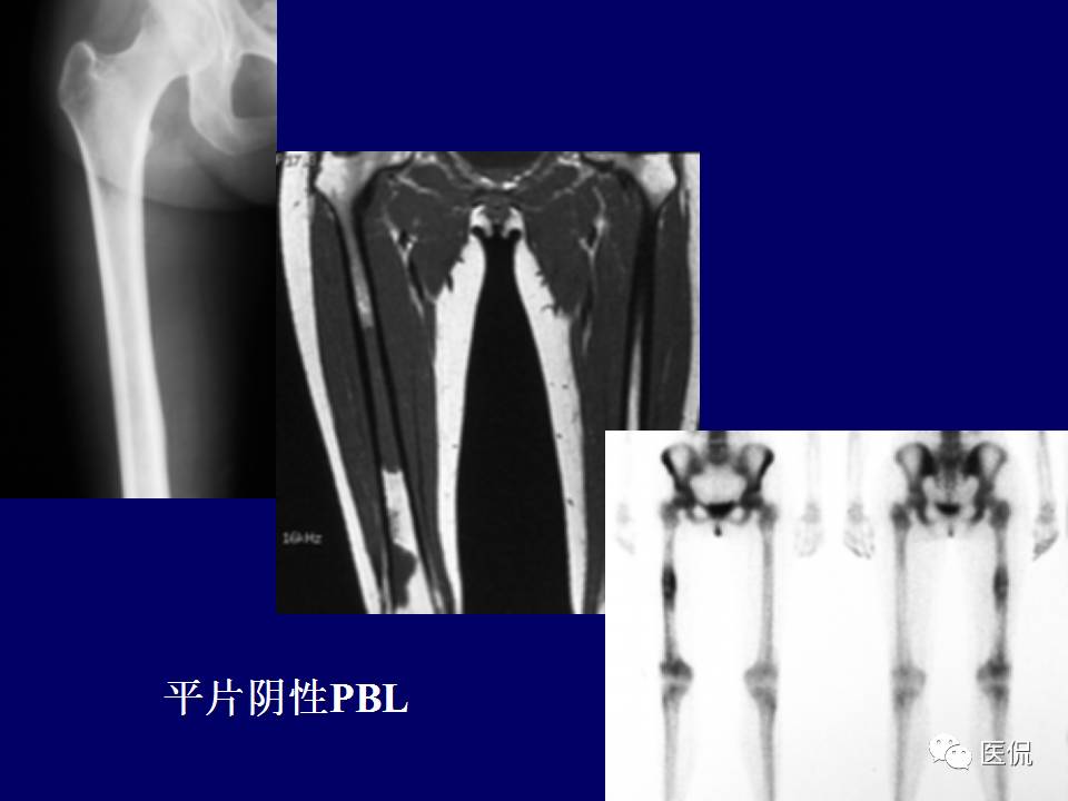 徐文坚老师精讲：原发性骨淋巴瘤影像学诊断医学影像精品PPT
