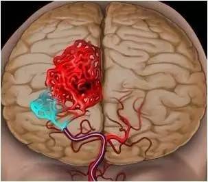 脑肿瘤1cm以内出血会怎样,脑肿瘤出血怎么治疗