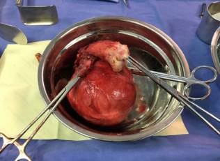 围手术期个案护理比赛优秀案例ppt,术后镇痛的规范化管理ppt