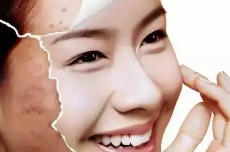 再也不担心脸上长痘痘,再也不用因为痘痘而烦恼