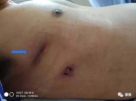 胸腔镜微创能切除多大的肿瘤,胸腔镜切除肿瘤