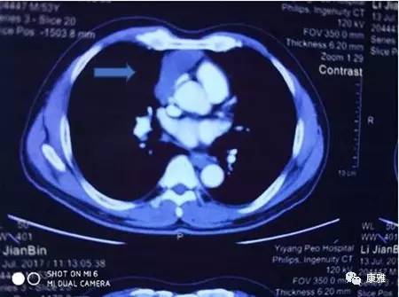 胸腔镜微创能切除多大的肿瘤,胸腔镜切除肿瘤