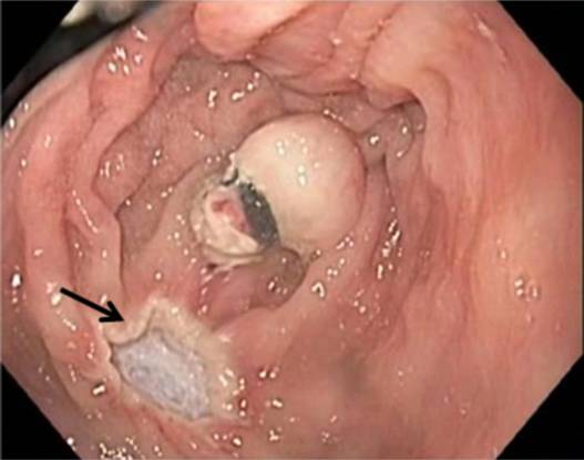 内镜下肌切开术手术步骤,肌肉活检最新技术
