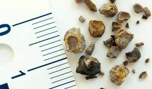 尿路结石多大可以自己排出,尿路结石冲击波碎石