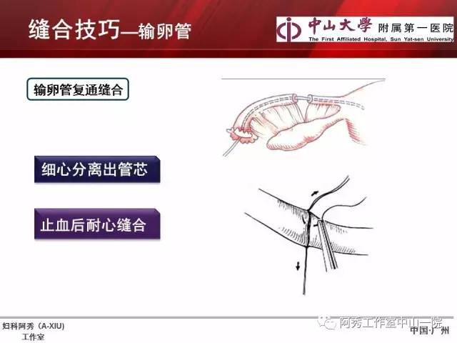 妇科腹腔镜下常用缝合技巧