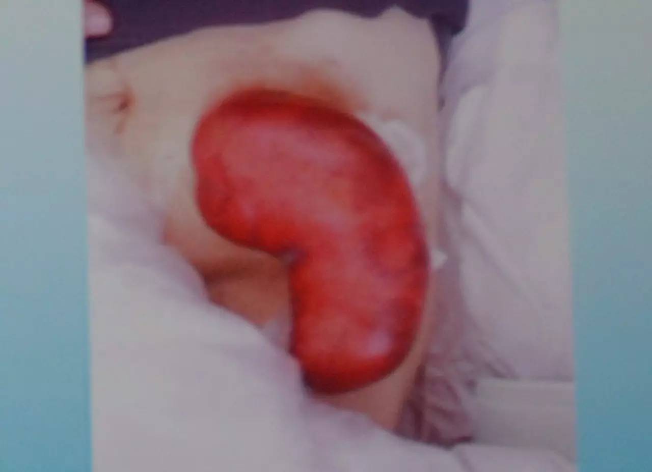 肠造口常见周围皮肤并发症,肠造口护理操作并发症