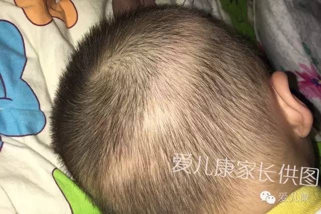 宝宝掉头发是甲功能异常吗,宝宝掉头发好不好