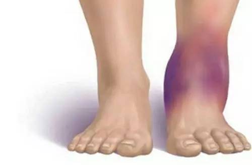 夏天如何保护脚踝不受凉,天气冷脚踝怎么保护