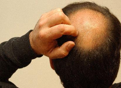 人为啥会秃,年少秃顶怎么治疗最好