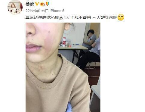 杨紫得荨麻疹面部红肿,杨紫皮肤过敏体质是什么