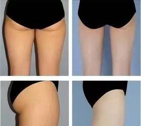 杏林微科普痔疮能自愈吗,杏林微资讯肛肠疾病