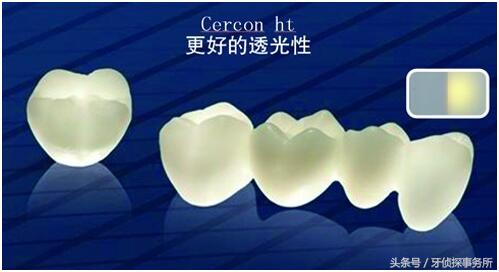 打桩后做的全瓷牙寿命是多久,韩国奥齿泰全瓷牙一般寿命多少年