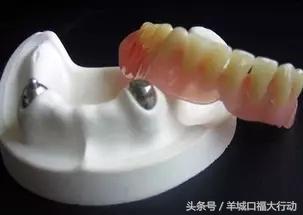 拔牙后可以直接镶牙吗,镶牙拔牙理论知识