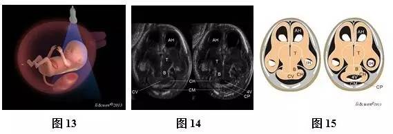 孕26周进行胎儿超声心动图检查,孕11-14周胎儿超声检测报告