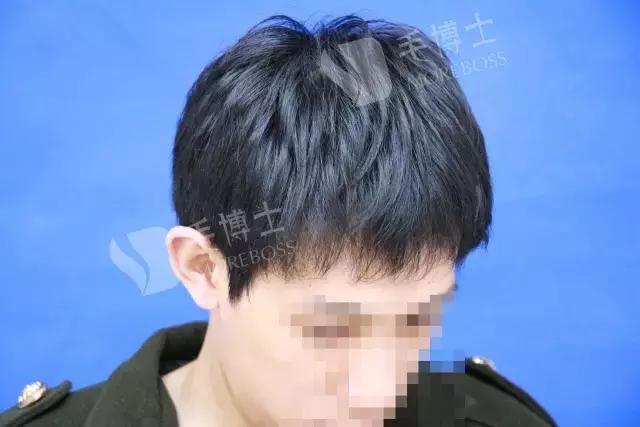 脱发到什么程度要去医院,脱发到什么等级