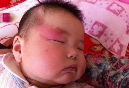 胎宝宝身上很多胎记是什么原因,孕妈以下行为会导致宝宝长胎记