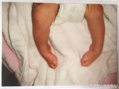 四维检查马蹄内翻有没有可能误诊,四维马蹄足和足内翻一样吗