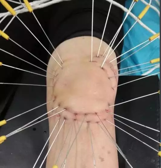 内热针是全针发热还是针尖发热,浮针治疗颈肩腰腿痛怎么样