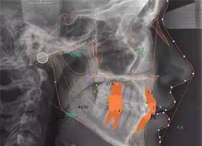 牙齿矫正钢牙套多少钱,淄博牙齿矫正多少钱